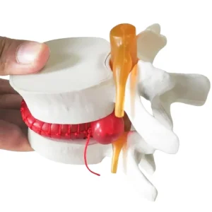 Hernia lumbar, ¿causa o consecuencia?