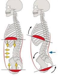 Tratamiento de la hernia lumbar
